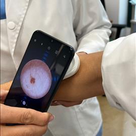Hospiten incorpora tecnología avanzada para la detección temprana de lesiones en la piel